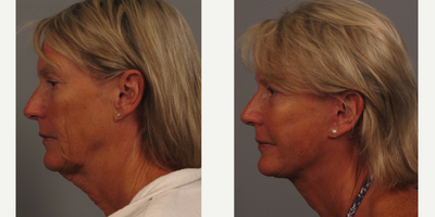 Facelift before and after photo