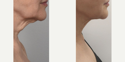 FaceTite before and after photo