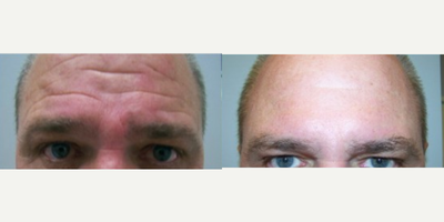 Botox before and after photo