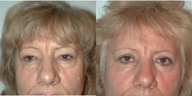 Eyelid Surgery before and after photo