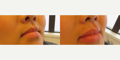Lip Fillers before and after photo