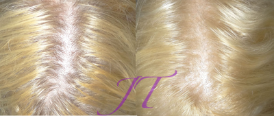 PRF Treatment before and after photo