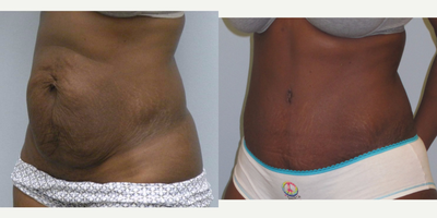 Tummy Tuck before and after photo
