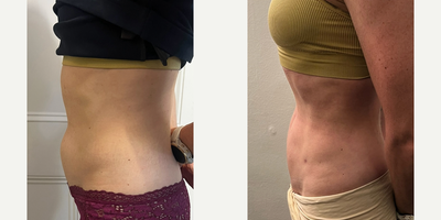 Abdominal Etching before and after photo