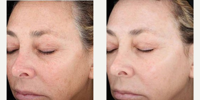 Chemical Peel before and after photo