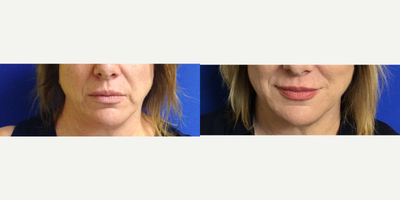 Dermal Fillers before and after photo