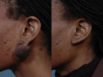 Facelift before and after photo