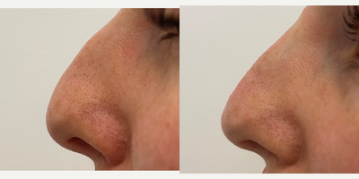 Nonsurgical Nose Job before and after photo
