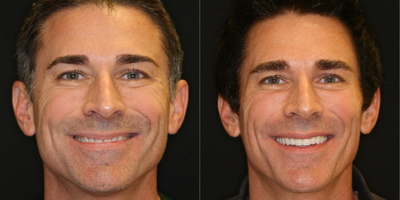 Smile Makeover before and after photo