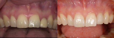 Dental Implants before and after photo