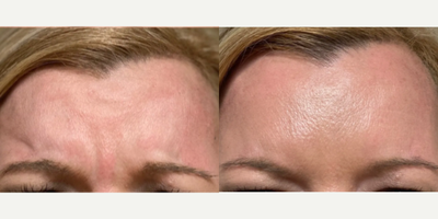 Dysport before and after photo