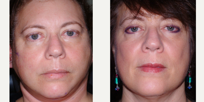 Facelift before and after photo