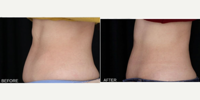 SculpSure before and after photo