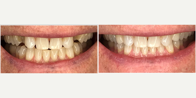 Dental Implants before and after photo