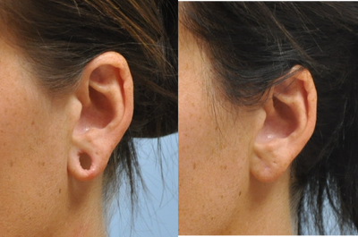 Earlobe Repair before and after photo