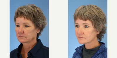 Facelift before and after photo