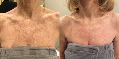 IPL before and after photo
