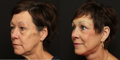 Laser Resurfacing before and after photo