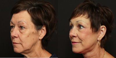 Laser Resurfacing before and after photo