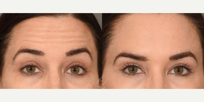 Botox before and after photo