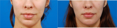 Buccal Fat Removal before and after photo
