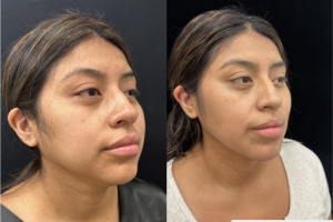 Chin Liposuction before and after photo