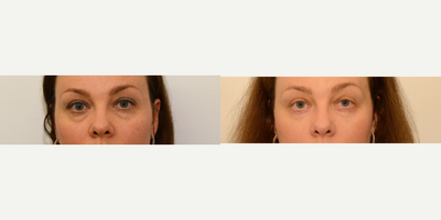 Eyelid Surgery before and after photo