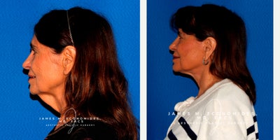 Facelift before and after photo