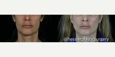 Facial Fat Transfer before and after photo