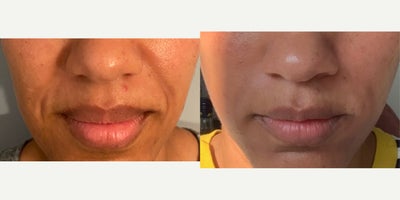 Juvederm before and after photo