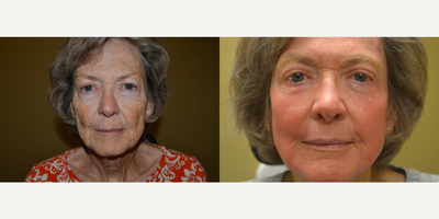 Laser Resurfacing before and after photo