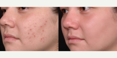 Laser Resurfacing before and after photo