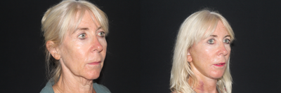 Lower Facelift before and after photo