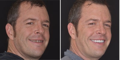 Porcelain Veneers before and after photo