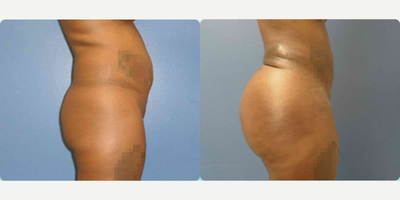 Brazilian Butt Lift before and after photo