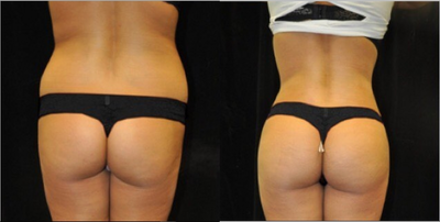 Brazilian Butt Lift before and after photo