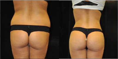 Brazilian Butt Lift before and after photo
