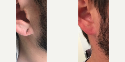 Earlobe Repair before and after photo