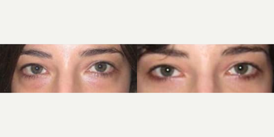 Eyelid Surgery before and after photo