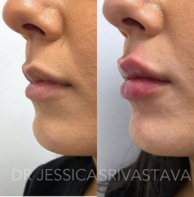 Lip Fillers before and after photo
