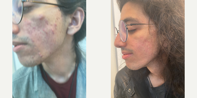 Scar Removal before and after photo