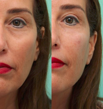 Belotero before and after photo