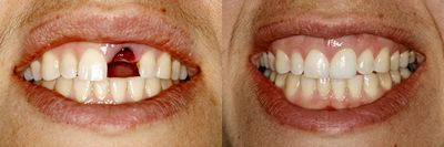 Dental Implants before and after photo