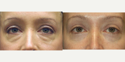 Eyelid Surgery before and after photo