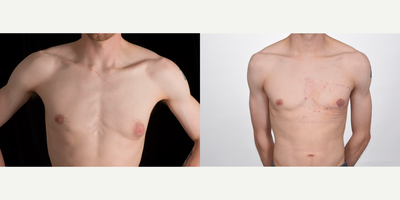 Gynecomastia Surgery before and after photo