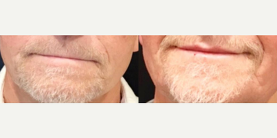 Lip Fillers before and after photo