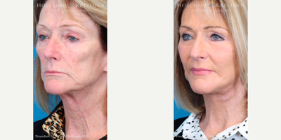 Cheek Augmentation before and after photo
