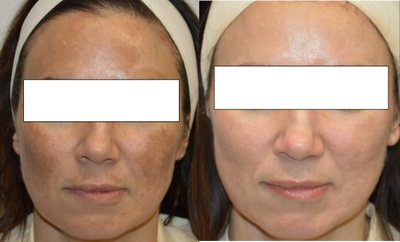 Chemical Peel before and after photo