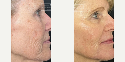 Juvederm before and after photo