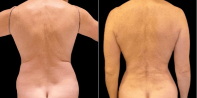 Liposuction before and after photo